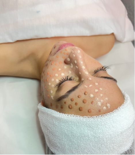 CURSO DERMAPEN / MICRONEEDLING BB GLOW