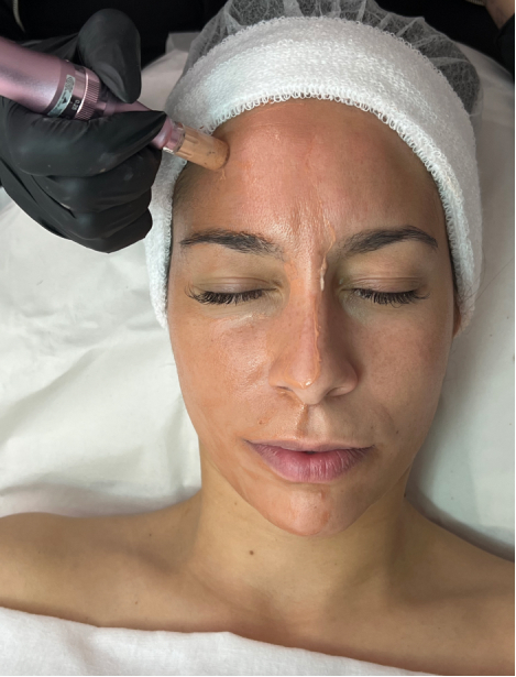 CURSO DERMAPEN / MICRONEEDLING BB GLOW