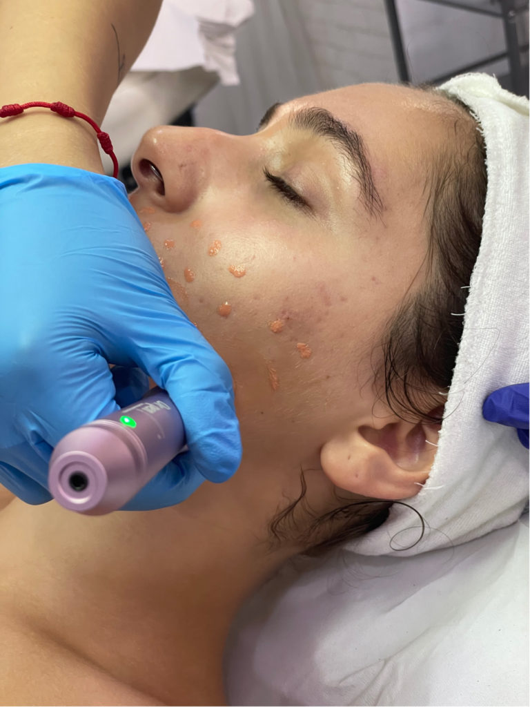 CURSO DERMAPEN / MICRONEEDLING BB GLOW